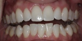 Angie's Teeth Before she used Invisalign and teeth whitening.